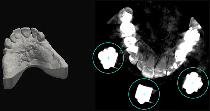 Scansione 3D e CBCT dello stesso paziente: il metallo si vede solo nella CBCT, insieme ai reperi dello stent