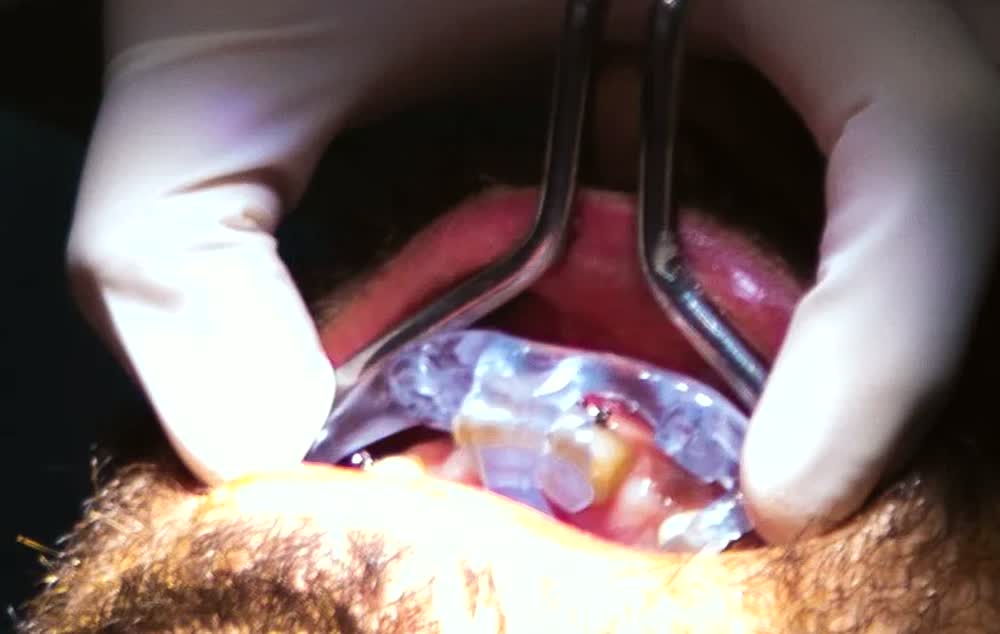 Caso reale: dima GuideX trasparente fissata con una mini-vite (PIN)